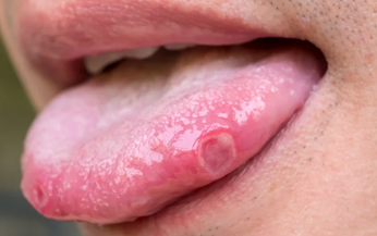 Bệnh mụn rộp sinh dục là gì? Biểu hiện mắc mụn rộp sinh dục