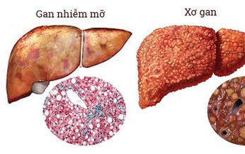 Ho&#224;ng kỳ - vị thuốc hỗ trợ trị gan nhiễm mỡ