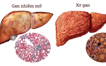 Gan nhiễm mỡ c&#243; mấy loại, cần ph&#226;n biệt như thế n&#224;o?