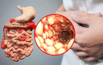 6 c&#225;ch ngăn chặn sự b&#249;ng ph&#225;t của bệnh Crohn