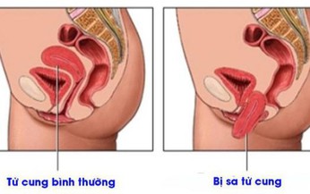 Nguy&#234;n nh&#226;n g&#226;y sa sinh dục v&#224; ai c&#243; nguy cơ bị sa sinh dục?