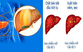 T&#225;c hại khi gan nhiễm mỡ v&#224; c&#225;ch hạn chế