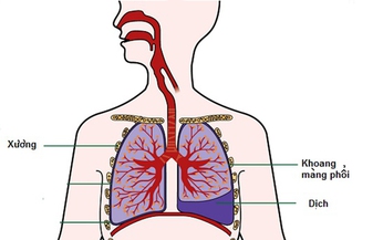 Tr&#224;n dịch m&#224;ng phổi: Nguy&#234;n nh&#226;n, biểu hiện v&#224; điều trị