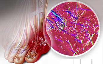 &#221; nghĩa việc x&#233;t nghiệm acid uric m&#225;u v&#224; giải ph&#225;p khi acid uric tăng