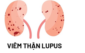 Bước ngoặt mới cho bệnh nh&#226;n vi&#234;m thận lupus