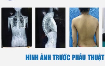 H&#224;nh tr&#236;nh t&#236;m lại d&#225;ng v&#243;c cho nữ sinh 15 tuổi bị vẹo cột sống do ngồi học sai tư thế