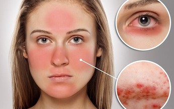 Biểu hiện của bệnh lupus ban đỏ hệ thống v&#224; c&#225;ch điều trị