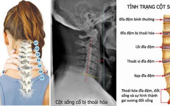 C&#225;ch l&#224;m gối thuốc chữa bệnh tho&#225;i h&#243;a cột sống cổ