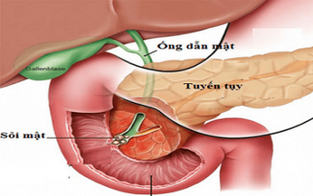 5 loại thực phẩm &#39;giết chết&#39; tuyến tụy