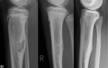 Trẻ sưng, đau chi kh&#244;ng r&#245; nguy&#234;n nh&#226;n rất c&#243; thể mắc ung thư xương ở giai đoạn sớm