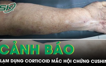 Cảnh b&#225;o hội chứng cushing do lạm dụng thuốc corticoid