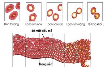 Loạn sản cổ tử cung: Nguy&#234;n nh&#226;n, triệu chứng, c&#225;ch điều trị v&#224; ph&#242;ng ngừa