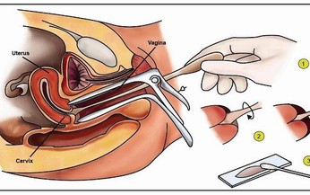 Thuốc v&#224; c&#225;c phương ph&#225;p điều trị bệnh loạn sản cổ tử cung