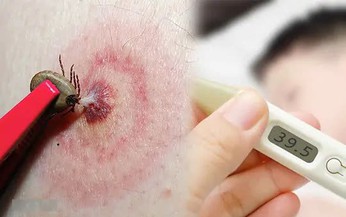 Babesia: Nguy&#234;n nh&#226;n, biểu hiện, c&#225;ch điều trị v&#224; ph&#242;ng bệnh