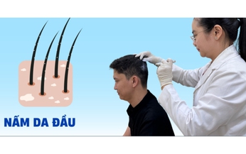 C&#226;u hỏi thường gặp li&#234;n quan đến nấm da đầu