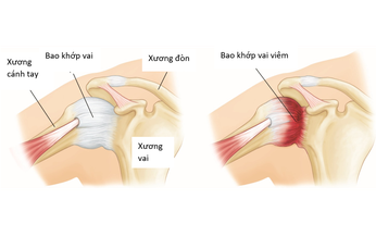 Vi&#234;m ch&#243;p xoay: Nguy&#234;n nh&#226;n, triệu chứng, c&#225;ch điều trị v&#224; c&#225;c biện ph&#225;p ph&#242;ng ngừa