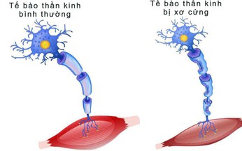 Thuốc điều trị bệnh xơ cột b&#234;n teo cơ