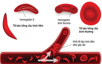 B&#224;i tập tốt cho người mắc bệnh hồng cầu lưỡi liềm