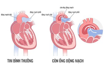 C&#226;u hỏi thường gặp về c&#242;n ống động mạch