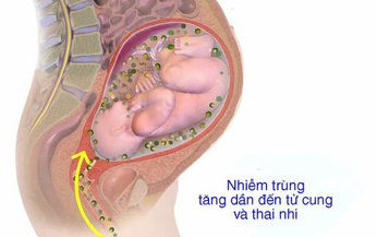 Bệnh vi&#234;m m&#224;ng ối: Nguy&#234;n nh&#226;n, triệu chứng, ph&#242;ng bệnh v&#224; c&#225;ch điều trị