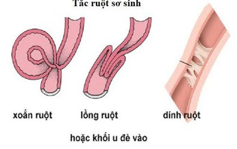 C&#226;u hỏi thường gặp li&#234;n quan đến bệnh tắc ruột sơ sinh