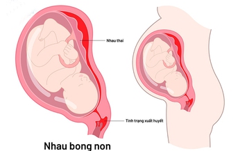 C&#225;c c&#226;u hỏi thường gặp li&#234;n quan đến nhau bong non