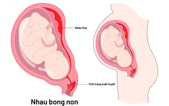 C&#225;c biện ph&#225;p xử tr&#237;, điều trị cho thai phụ bị nhau bong non