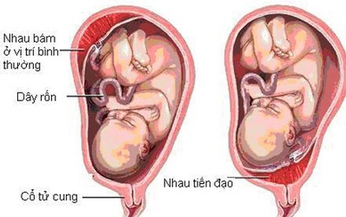 Nhau tiền đạo: Nguy&#234;n nh&#226;n, triệu chứng, c&#225;ch điều trị v&#224; ph&#242;ng ngừa