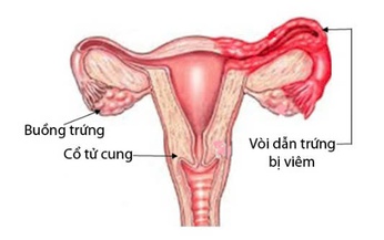 Vi&#234;m ống dẫn trứng: Nguy&#234;n nh&#226;n, triệu chứng, ph&#242;ng bệnh v&#224; c&#225;ch điều trị