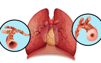 6 c&#226;u hỏi thường gặp về bệnh gi&#227;n phế quản