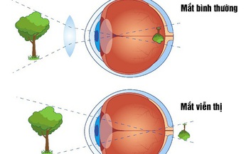 C&#226;u hỏi thường gặp li&#234;n quan đến viễn thị