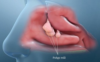 Polyp mũi: Nguy&#234;n nh&#226;n, triệu chứng, c&#225;ch điều trị v&#224; ph&#242;ng bệnh