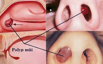 C&#226;u hỏi thường gặp li&#234;n quan đến bệnh polyp mũi