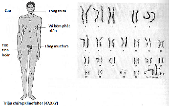 Hội chứng XYY c&#243; chữa được kh&#244;ng?