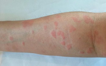 Thuốc điều trị lupus ban đỏ