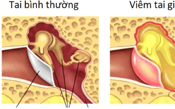 Người bệnh vi&#234;m tai giữa tập luyện như thế n&#224;o?