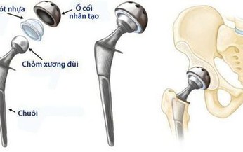 C&#225;c phương ph&#225;p điều trị hoại tử chỏm xương đ&#249;i