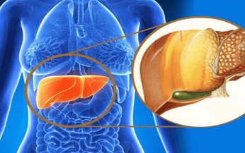 Bệnh gan nhiễm mỡ do rượu l&#224; g&#236;?