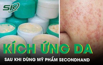 Phồng rộp môi sau khi dùng mỹ phẩm 'secondhand'