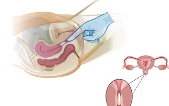 Biện ph&#225;p điều trị nấm Candida &#226;m đạo