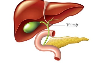 Polyp túi mật là gì? Khi nào cần điều trị?