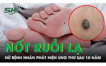 Phát hiện ung thư từ nốt ruồi dưới lòng bàn chân