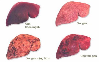 C&#225;c dấu hiệu cảnh b&#225;o ung thư gan