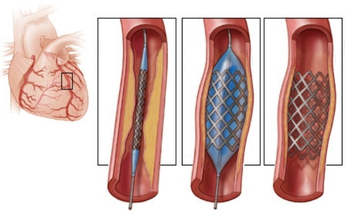 4 điều cần ch&#250; &#253; sau khi đặt stent động mạch v&#224;nh