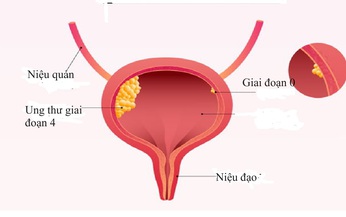 Điều trị ung thư b&#224;ng quang