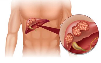 Ung thư gan c&#243; chữa khỏi được kh&#244;ng?