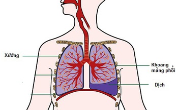 Chế độ ăn cho người bệnh tr&#224;n dịch m&#224;ng phổi