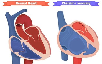 Tim bẩm sinh Ebstein: Nguy&#234;n nh&#226;n, triệu chứng, c&#225;ch điều trị