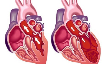 Suy tim tr&#225;i: Nguy&#234;n nh&#226;n, triệu chứng, c&#225;ch điều trị v&#224; ph&#242;ng bệnh