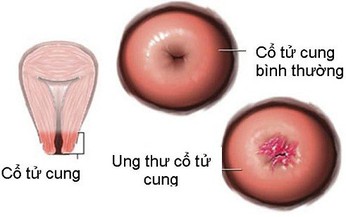 Người bệnh ung thư tử cung n&#234;n vận động như thế n&#224;o?